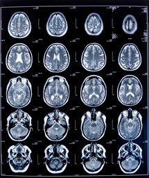 Professional rugby may be associated with changes in brain structure ...